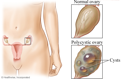 The Abortion Pill and PCOS. Polycystic Ovary Syndrome is a common hormonal disorder among women in their childbearing age.